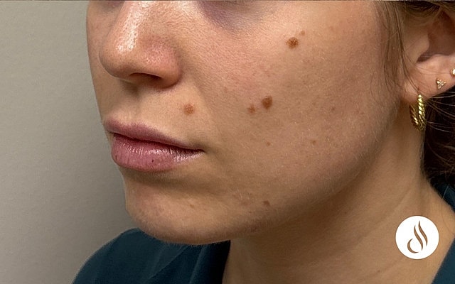 Close-up of skin with beauty marks and blemishes.