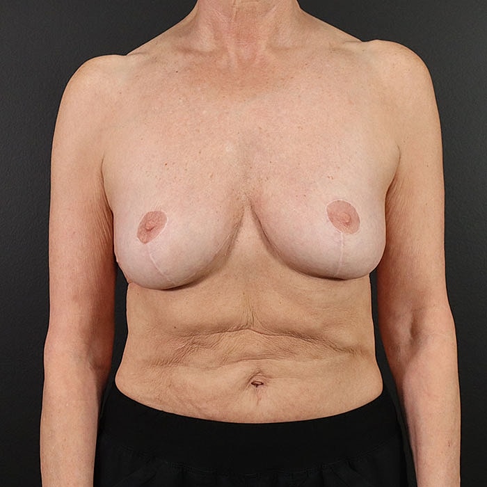 Breast Implant Removal With Mastopexy Before & After