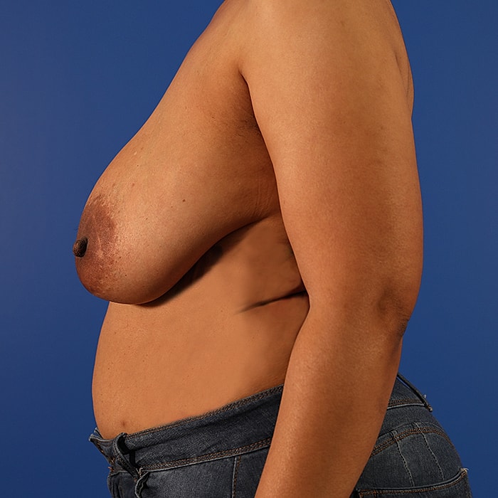 Mastopexy Before & After