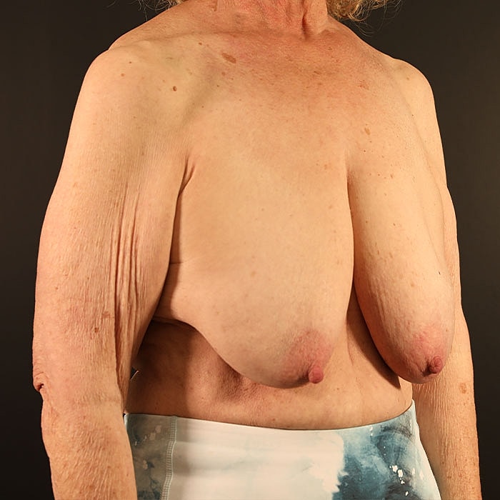 Mastopexy Before & After