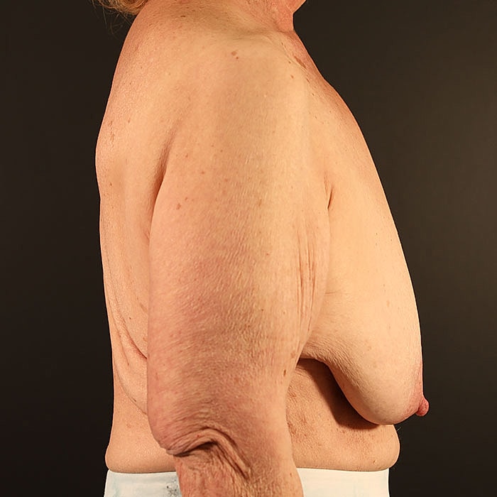 Mastopexy Before & After