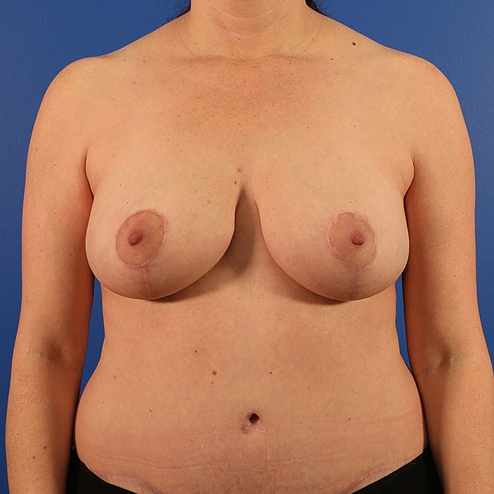 Mastopexy Before & After