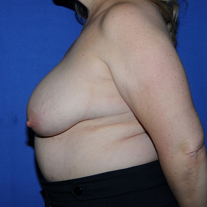 Mastopexy Before & After