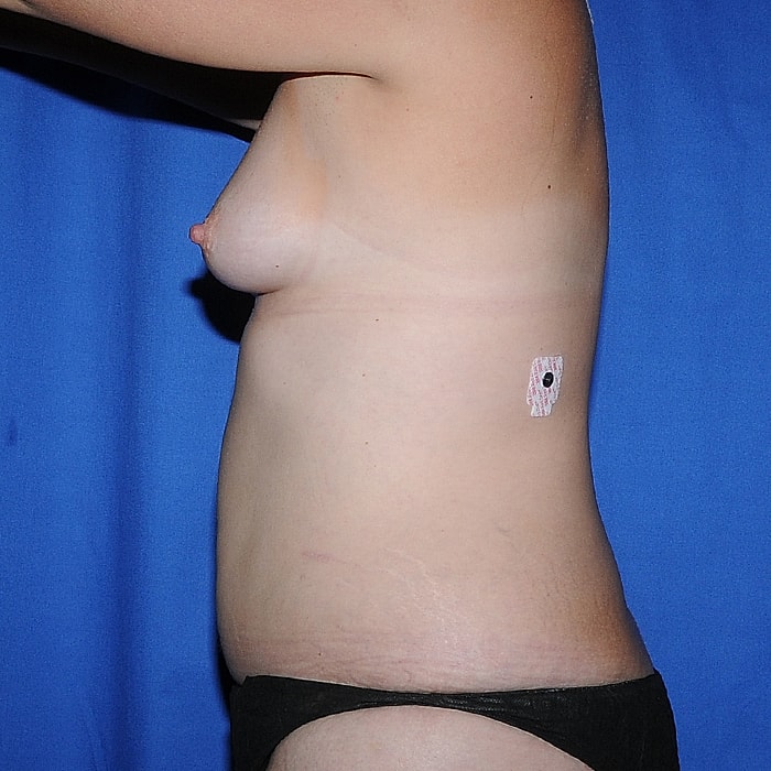 4 Flap Before & After