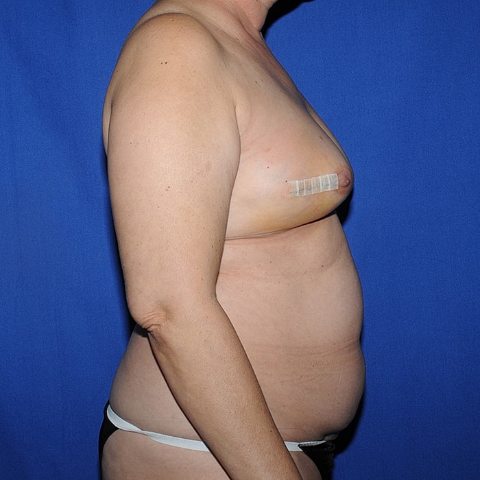 4 Flap Before & After