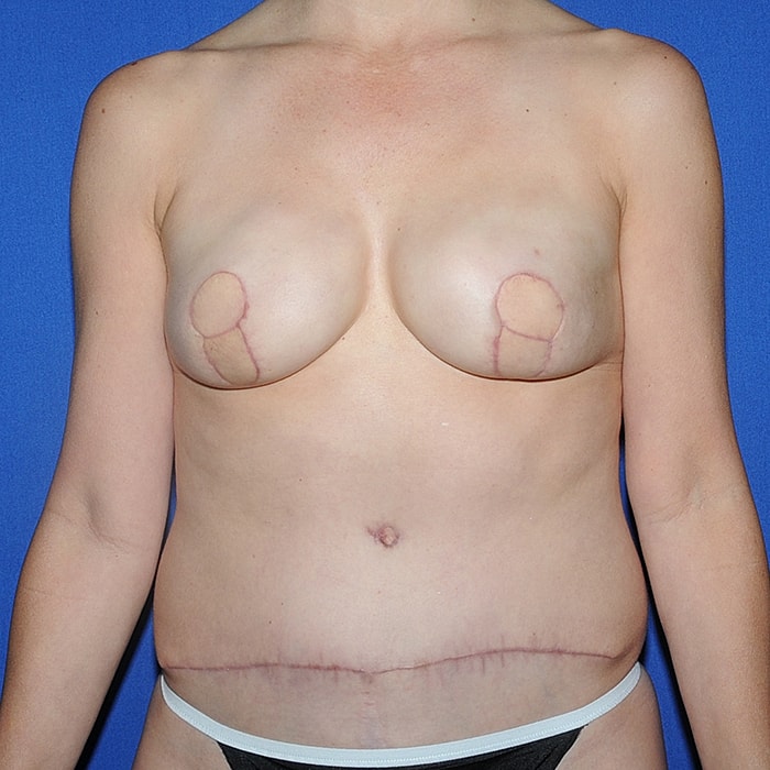 4 Flap Before & After