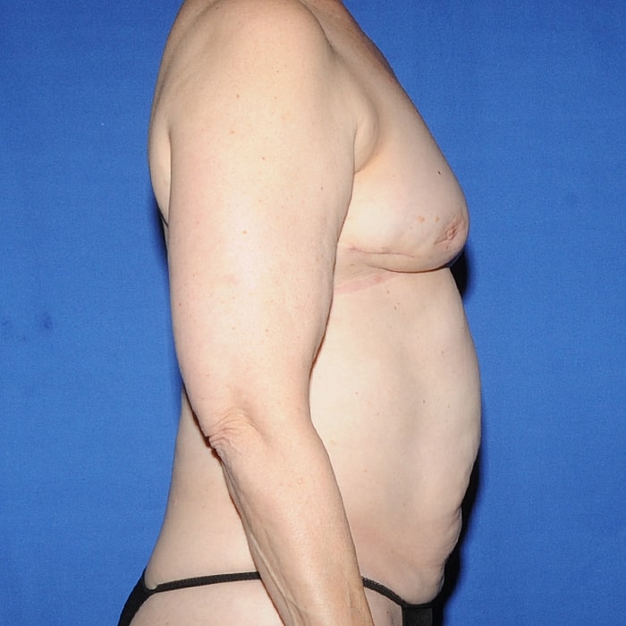 4 Flap Before & After