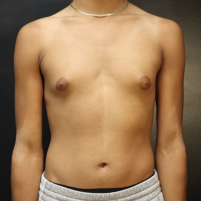 Gynecomastia Before & After
