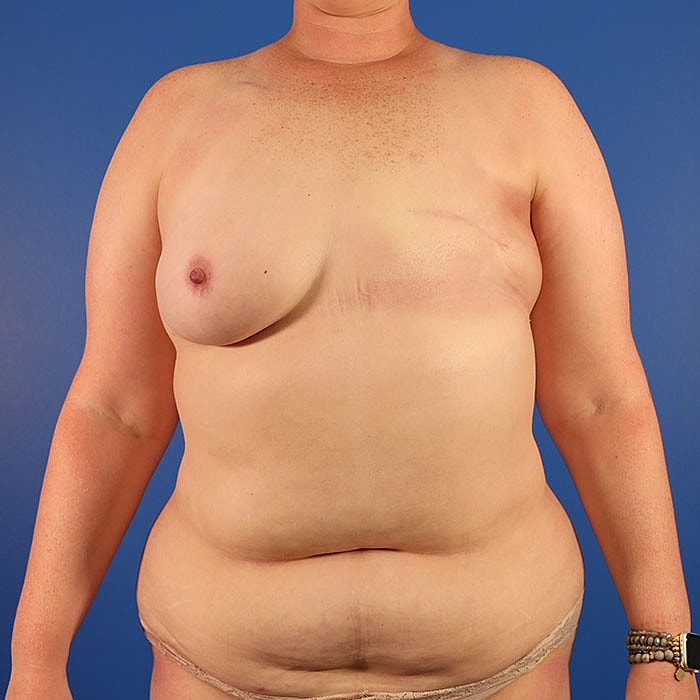 Unilateral Stacked DIEP Before & After