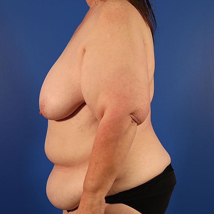 Unilateral Stacked DIEP Before & After