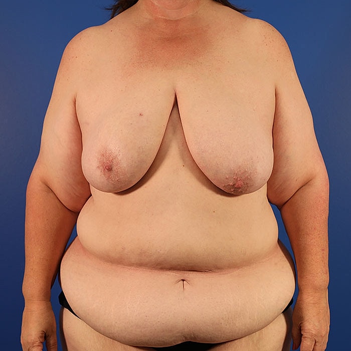 Unilateral Stacked DIEP Before & After