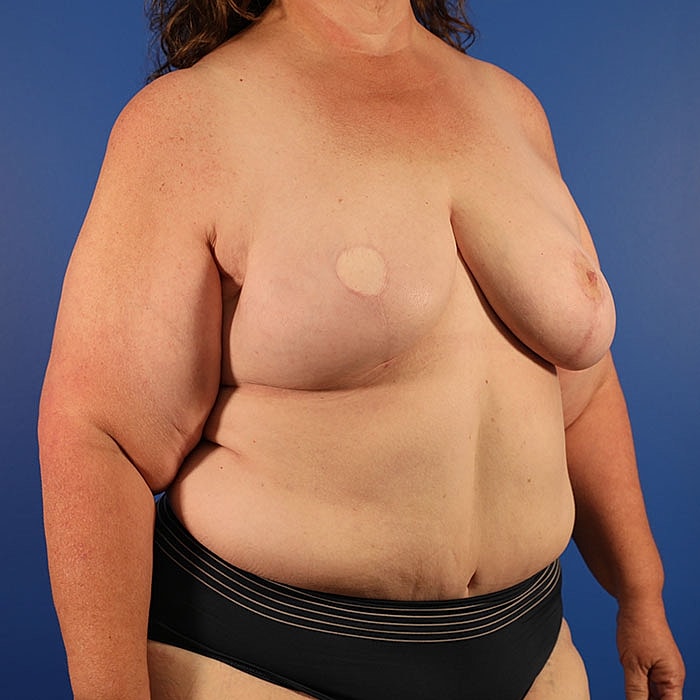 Unilateral Stacked DIEP Before & After