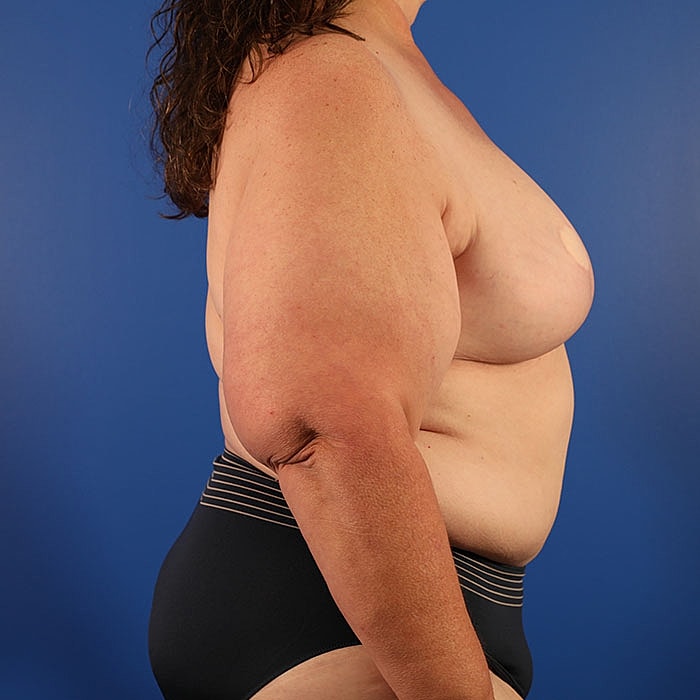 Unilateral Stacked DIEP Before & After