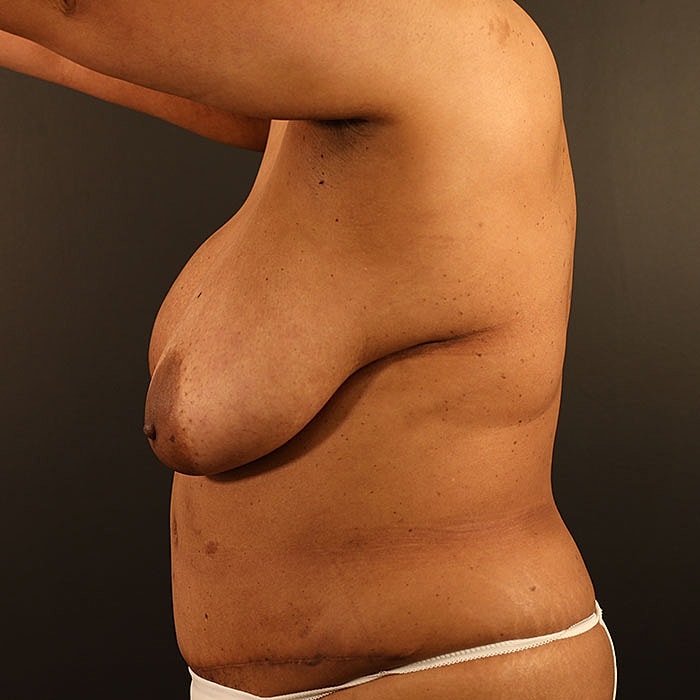 Unilateral Stacked DIEP Before & After