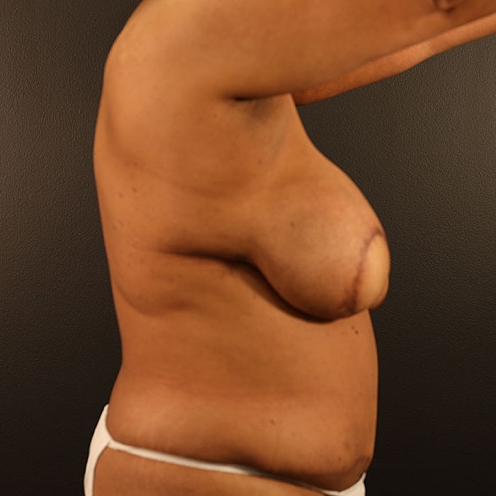 Unilateral Stacked DIEP Before & After