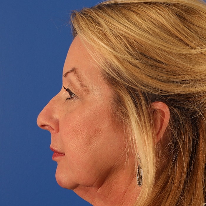 Blepharoplasty Before & After