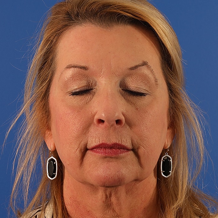 Blepharoplasty Before & After