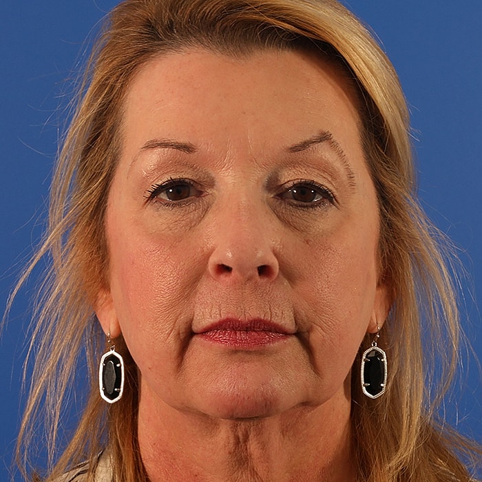 Blepharoplasty Before & After