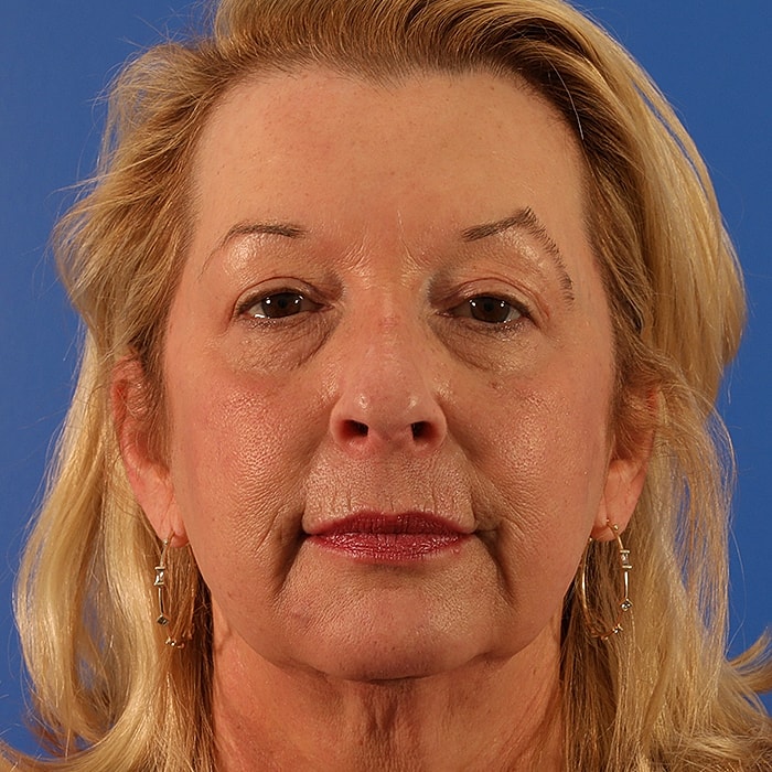 Blepharoplasty Before & After