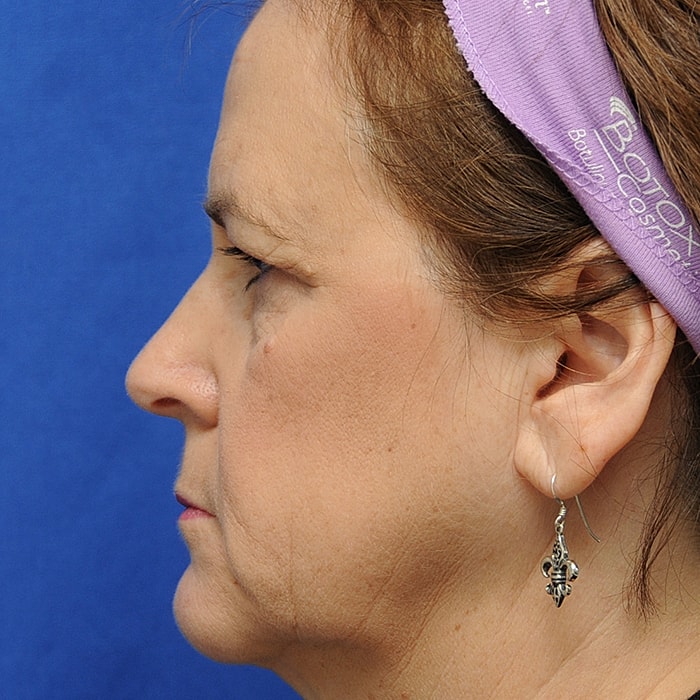 Blepharoplasty Before & After