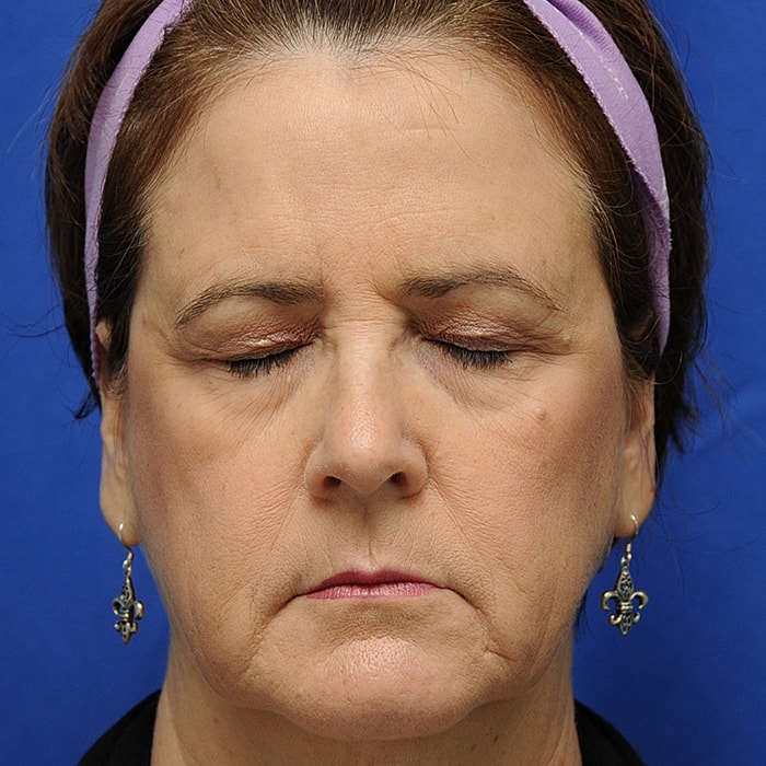 Blepharoplasty Before & After