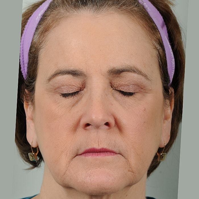 Blepharoplasty Before & After