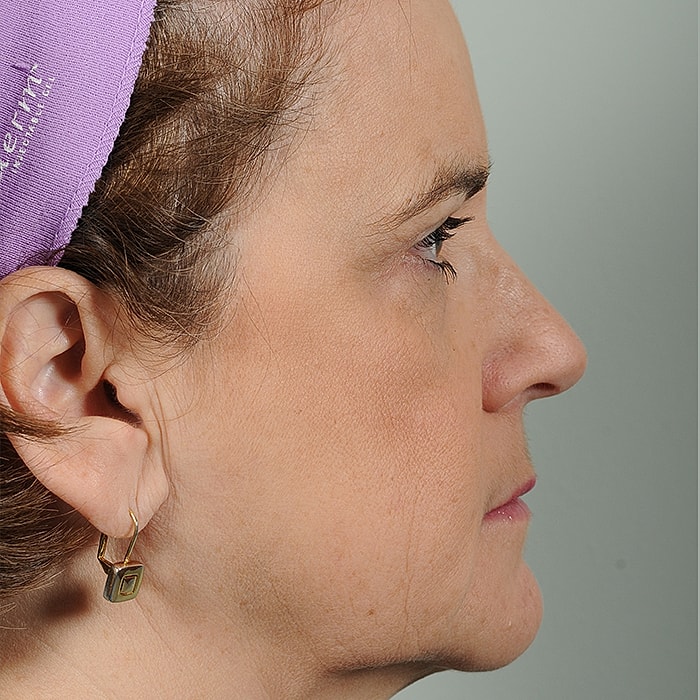 Blepharoplasty Before & After