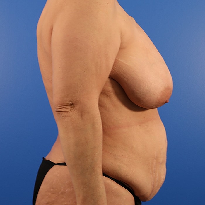 DIEP With Implants Before & After