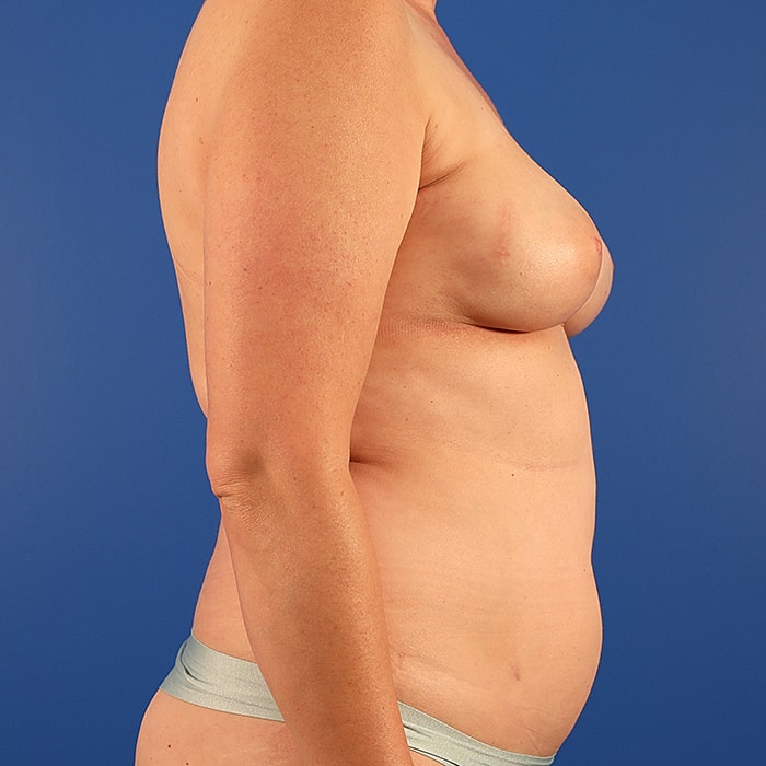 DIEP With Implants Before & After