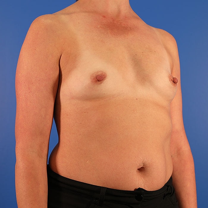 Breast Augmentation Before & After