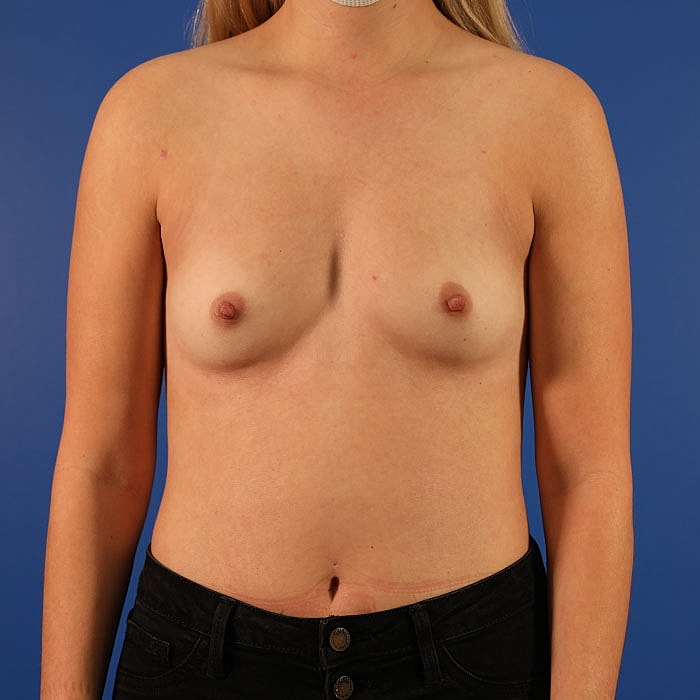Breast Augmentation Before & After