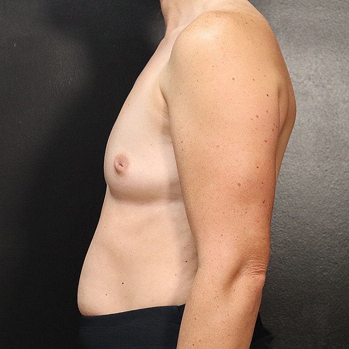Breast Augmentation Before & After