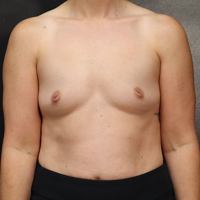 Breast Augmentation Before & After