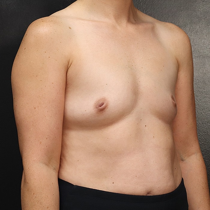 Breast Augmentation Before & After