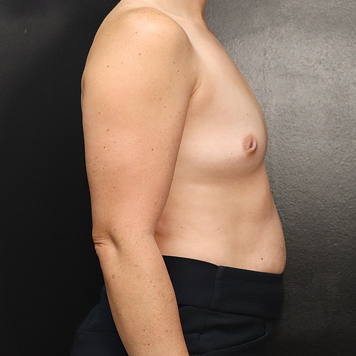 Breast Augmentation Before & After