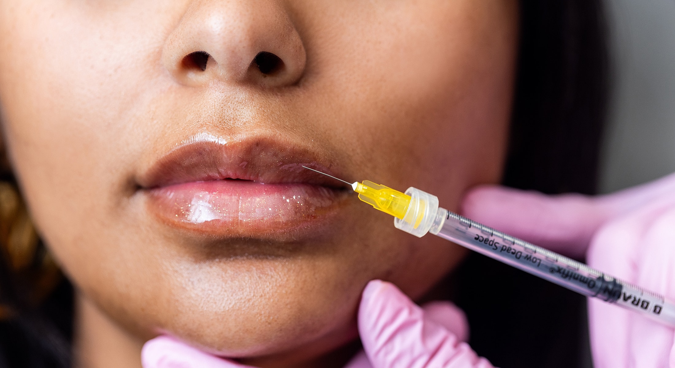 Injection procedure for lip enhancement.