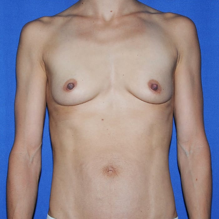 Breast Augmentation Before 14