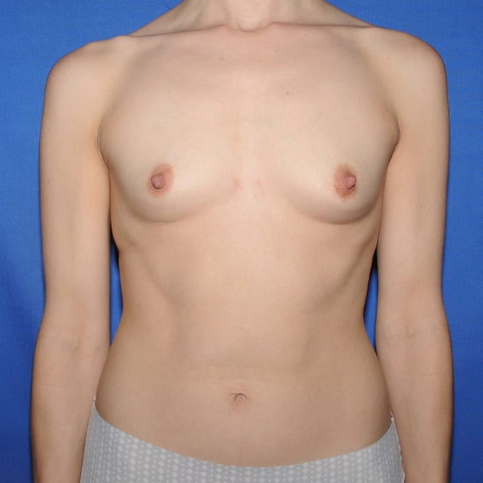 Breast Augmentation Before 16
