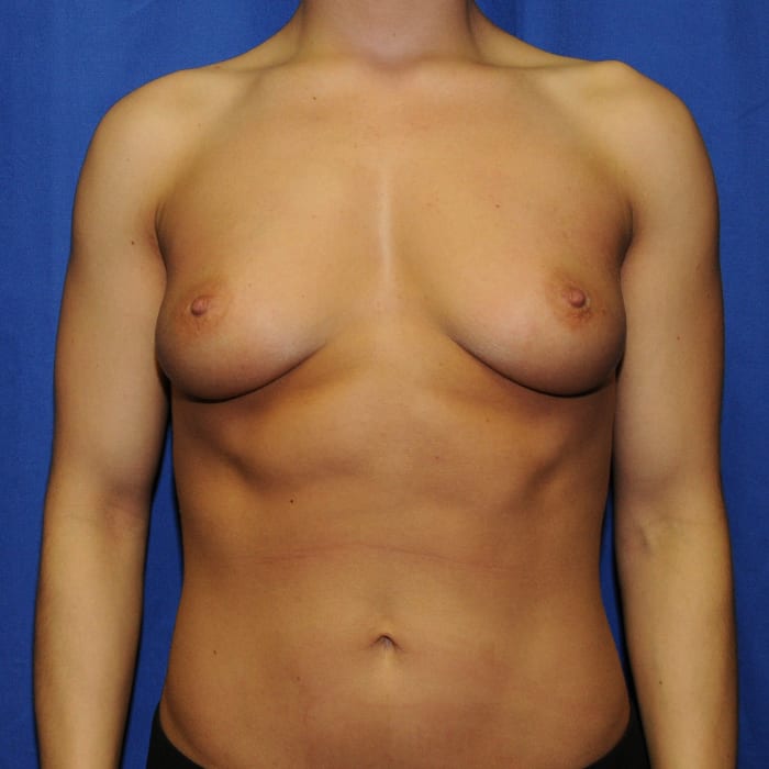 Breast Augmentation Before 10