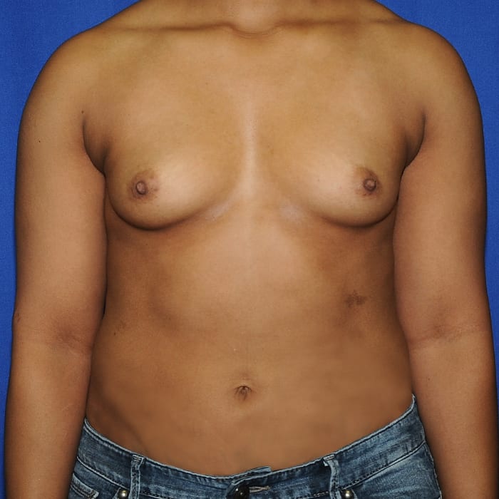 Breast Augmentation Before 11
