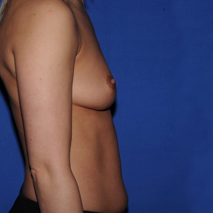 Breast Augmentation Before 5