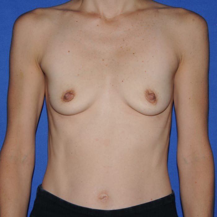 Breast Augmentation Before 3