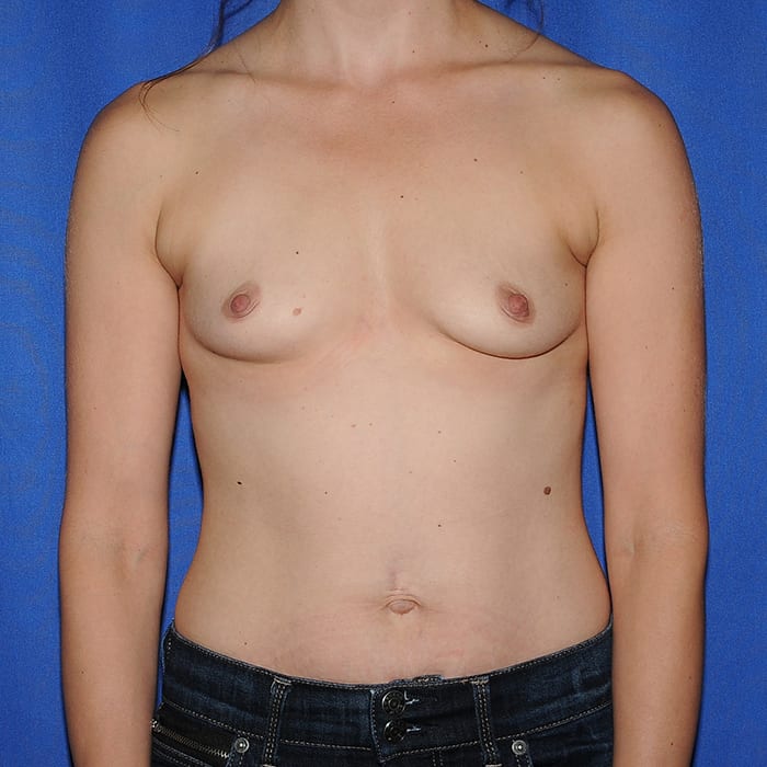 Breast Augmentation Before 12